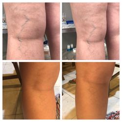 Schulman Vein and Laser Center