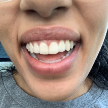 Stiles Dentistry - Before with old "filled in" chip - Cosmetic Dentists Near Me - Gaithersburg, Maryland