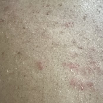 Courtyard by Marriott St. Augustine Beach - BED BUG BITES! - Hotels Near Me - St. Augustine, Florida