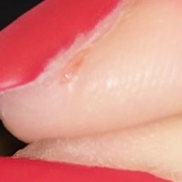 Infected cuticles