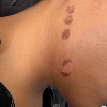 LaserAway Reno - 3rd Day - Laser Hair Removal Near Me - Reno, Nevada