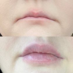 Laser Sculpture - Before and after (first time!) without makeup