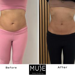 Muse Body Sculpting