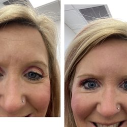 Mekari Dental Studio & Spa - Botox done 3/14