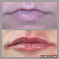 Inner Glow Aesthetics - Before/ After Lip Fillers