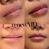glutathione injections reddit reviews Arencia Vitamin C Booster Shot Serum with Glutathione, Niacinamide and Vitamin E for Dark Spot Care, Fine Lines & Wrinkles, Glass Skin, Korean Skincare 30ml/1.01 fl.oz : Beauty & Personal Care cymbiotika glutathione reviews reddit Liposomal