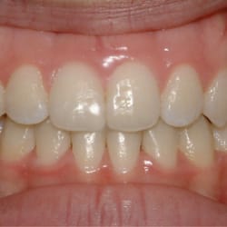 Peter Roth, DDS MSD - Rachel- After (20 months with Damon braces)