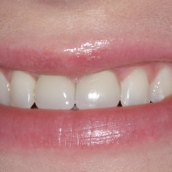 James Khazian, DMD - Dental Implant Centers - 2 missing upper front teeth replaced with dental implants