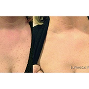 Alpine Laser Clinic - Lumecca - Body Contouring Near Me - Eagle, Colorado