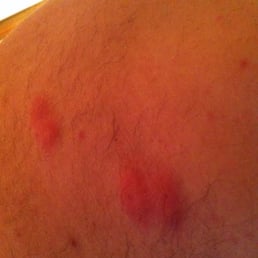 Bedbugs after a stay at the Super 8 Canton hotel. Bedbugs after a stay at the Super 8 Canton hotel.