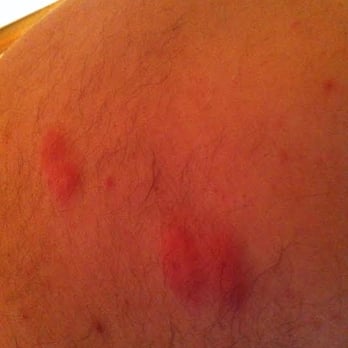 Super 8 Motel - Bedbugs after a stay at the Super 8 Canton hotel. - Hotels Near Me - Dallas, Texas Super 8 Motel - Bedbugs after a stay at the Super 8 Canton hotel. - Hotels Near Me - Dallas, Texas