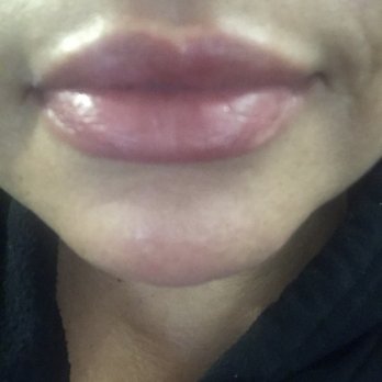 The Beauty Medics - Not too much swelling - Medical Spas Near Me - Riverside, California The Beauty Medics - Not too much swelling - Medical Spas Near Me - Riverside, California