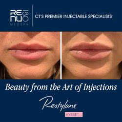 Re:nu 180 Medspa - #RestylaneKysse Results!