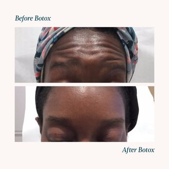 Ever/Body SoHo - Before & After Botox. - Skin Care Near Me - New York, New York