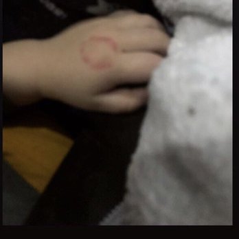 Kids Corner - The bite he came home with,no accident report and no call warning us about this incident. - Child Care & Day Care Near Me - Bothell, Washington