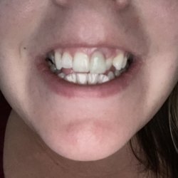DentalWorks & Orthodontics Royal Oak - See how the gum is cut away? This was done to her by Dr. Rice.