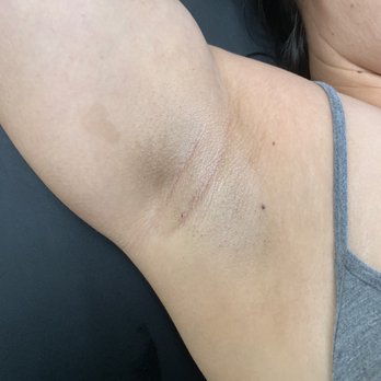 Centered Aesthetics - Immediately after underarm wax service - Waxing Near Me - Oakland , California