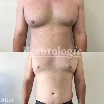 Jon Wilensky, MD, MBA, FACS - Gynecomastia Reduction Before and After - Plastic Surgeons Near Me - Temecula, California Jon Wilensky, MD, MBA, FACS - Gynecomastia Reduction Before and After - Plastic Surgeons Near Me - Temecula, California