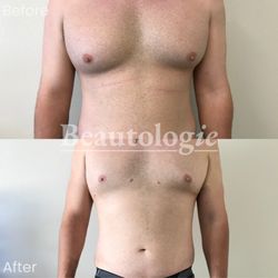 Jon Wilensky, MD, MBA, FACS - Gynecomastia Reduction Before and After