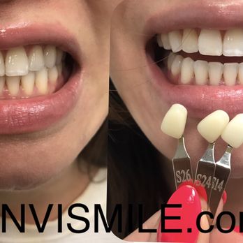 Envismile - ZOOMstyle Teeth Whitening
‍ Dental Hygienist - Teeth Whitening Near Me - Dallas, Texas