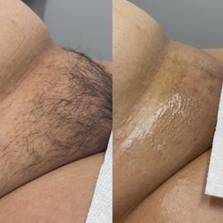 Bare Botanicals Waxing - Before + after brazilian wax