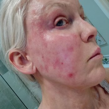 Robert Shumway, MD - One pic of the left side of my face. Taken 5/12/20. Almost 5 months after surgery. You can see the facial scarring. - Cosmetic Surgeons Near Me - San Diego, California Robert Shumway, MD - One pic of the left side of my face. Taken 5/12/20. Almost 5 months after surgery. You can see the facial scarring. - Cosmetic Surgeons Near Me - San Diego, California