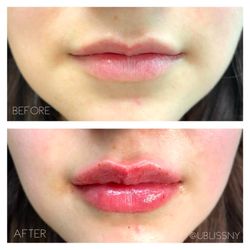 Ubliss Medical Aesthetics - Lip Filler(2)