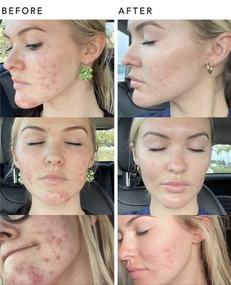 Salt Facial Before & After - The Salt Facial can treat active acne for kids even as young as 12 years old!! After doing treatment with Gavin with accutane, which is a high risk medication, I wish this would have been an option!! Salt Facial Before & After - The Salt Facial can treat active acne for kids even as young as 12 years old!! After doing treatment with Gavin with accutane, which is a high risk medication, I wish this would have been an option!!