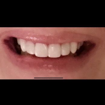 Giannina Gwen, DDS - ...This is ONLY her Bonding technique... She's replacing this with Veneers...!!! - General Dentistry Near Me - Bayonne, New Jersey Giannina Gwen, DDS - ...This is ONLY her Bonding technique... She's replacing this with Veneers...!!! - General Dentistry Near Me - Bayonne, New Jersey