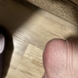 Cracked skin that wasn't buffed over. Cracked skin that wasn't buffed over.