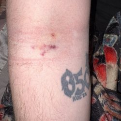 BioLife Plasma Services - Scarring, bruising, swelling.