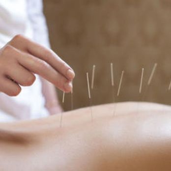 Ling Li Acupuncture - Acupuncture Near Me - Surrey, British Columbia Ling Li Acupuncture - Acupuncture Near Me - Surrey, British Columbia