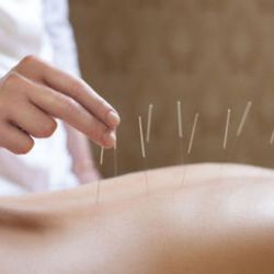 Ling Li Acupuncture