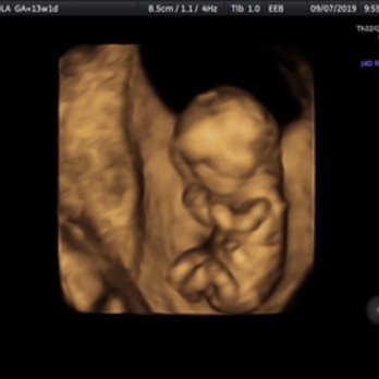 Inside View 3D/4D Ultrasound - Diagnostic Imaging Near Me - Lacey, Washington