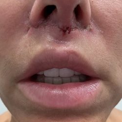 Gregory Branham, MD - One week post op