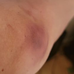 Vitalant Blood Donation- Redding - Blown vein.