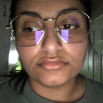 Kathy Aronson, RN BSN - 3 weeks healed after the 2nd session with .7ml. You can see how overfilled and botched I look. - Medical Spas Near Me - San Jose, California