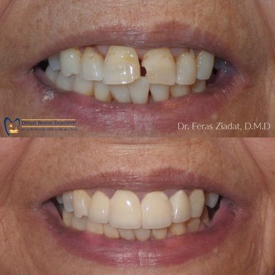 Before & After - Desert Breeze Dentistry is a Tempe based family dentist practice that treats patients of all ages. We are committed to delivering the highest quality dental care and do so using advanced dental equipment. We are a cosmetic dentist that offers services like checkups, teeth cleaning, crowns, veneers and more. Before & After - Desert Breeze Dentistry is a Tempe based family dentist practice that treats patients of all ages. We are committed to delivering the highest quality dental care and do so using advanced dental equipment. We are a cosmetic dentist that offers services like checkups, teeth cleaning, crowns, veneers and more.
