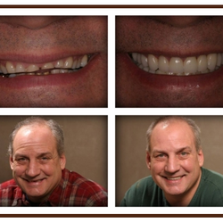 Preet Sandhu, MD - Crystal Family Dental Care - Smile Makeover Patient 2