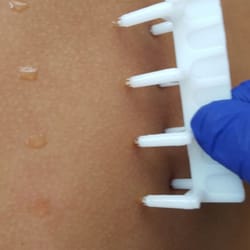 Aloha Allergy and Immunology - Multi-Prick testing. No needles