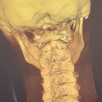 Upper Cervical Spine Care - After the scan, Cecilia looks at the c1, C2 to see if there is any misalignment. I look pretty from this angle. Lol. - Chiropractors Near Me - Los Angeles, California Upper Cervical Spine Care - After the scan, Cecilia looks at the c1, C2 to see if there is any misalignment. I look pretty from this angle. Lol. - Chiropractors Near Me - Los Angeles, California