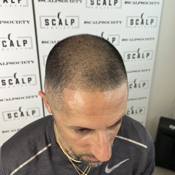 Scalp Society - Before pic taken at Scalp Society - Hair Loss Centers Near Me - San Jose, California