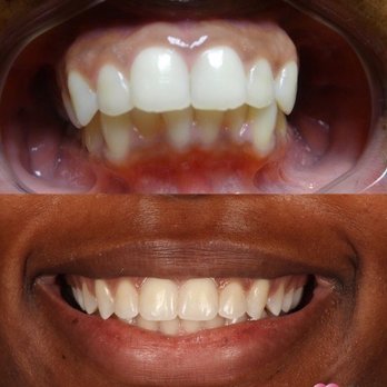 Heart Dental - Before and After Braces - General Dentistry Near Me - Carson, California