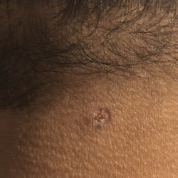 Astra Skin And Laser Solutions - After