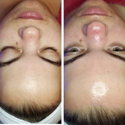 Michelle Esthetics - Signature Hydrafacial