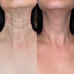 Botox for Platysma