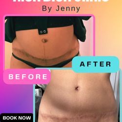 Rich Bich Clinic - #surgicalscarring #beforeandafterscars #scarreivision Treated with the co2 laser
