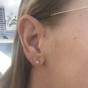 Jae Chun, MD - After Chun reattached my ear (see before picture I attached as well.) This guy ROCKS!!! - Cosmetic Surgeons Near Me - Newport Beach, California Jae Chun, MD - After Chun reattached my ear (see before picture I attached as well.) This guy ROCKS!!! - Cosmetic Surgeons Near Me - Newport Beach, California