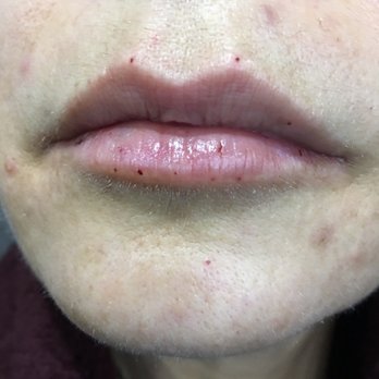 Juvly Aesthetics - Right after! - Medical Spas Near Me - Cincinnati, Ohio Juvly Aesthetics - Right after! - Medical Spas Near Me - Cincinnati, Ohio