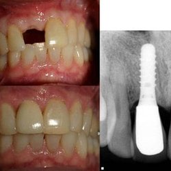 The Downey Dentist - We Offer Same Day Dental Implants. Restore Your Smile with a Fixed and Affordable Solution.